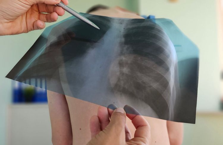Hausse de cas de tuberculose infantile : faut-il s'inquiéter ?