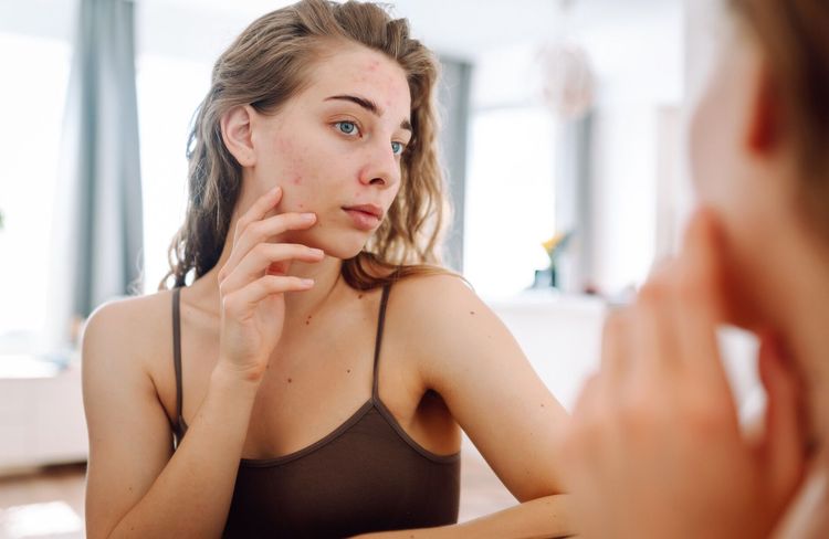 Acné adulte : les 3 actifs à adopter dès le matin pour une peau plus nette