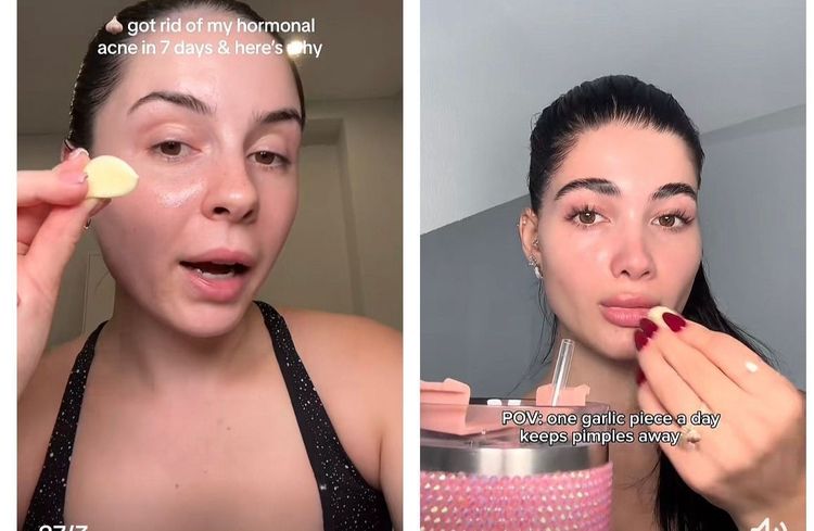 Acné : l’ail cru, le nouveau remède naturel anti-bouton ?