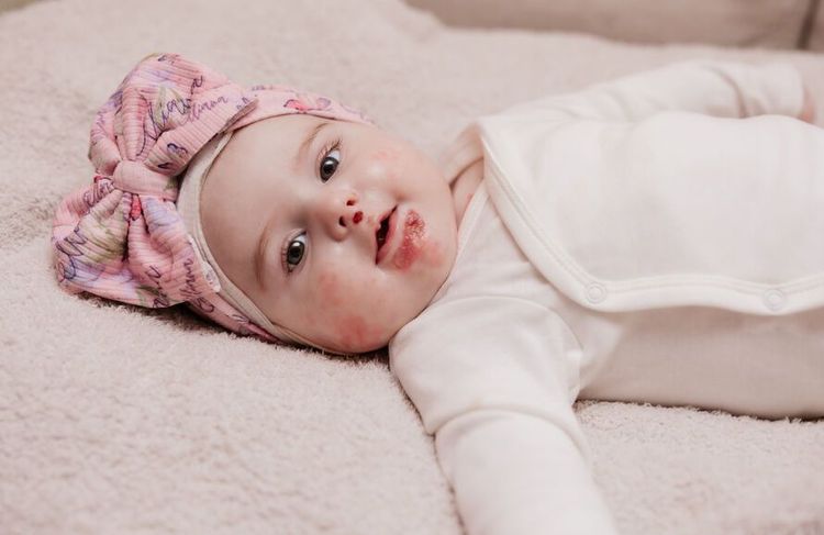 Qu’est-ce que l'épidermolyse bulleuse jonctionnelle, cette maladie rare  qui touche les bébés ?