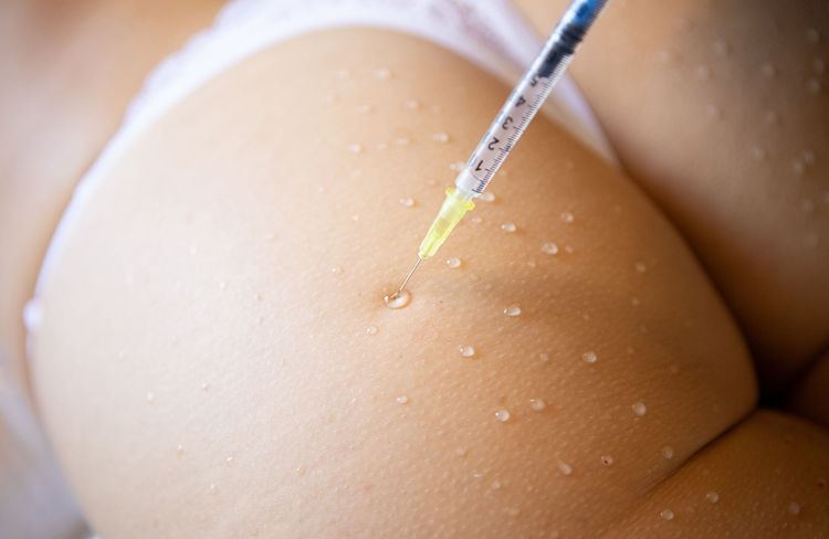 Qu’est-ce que le « BBL Filler », cette technique d'injections dans les fesses qui inquiètent les médecins ?