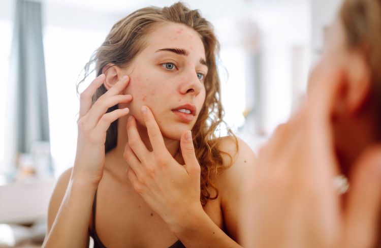 Acné : voici pourquoi vous avez plus de boutons à l’automne