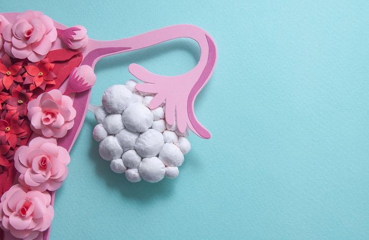 Qu’est-ce que le SOPK, première cause d’infertilité féminine ?