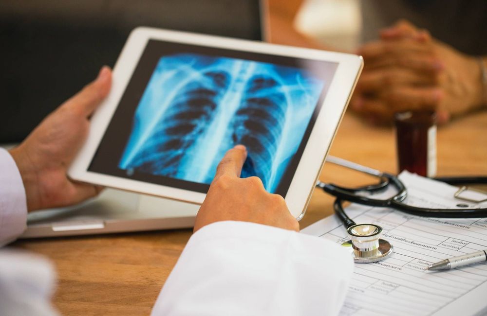 Cancer du poumon : pourquoi les femmes et les non-fumeurs sont de plus en plus à risque