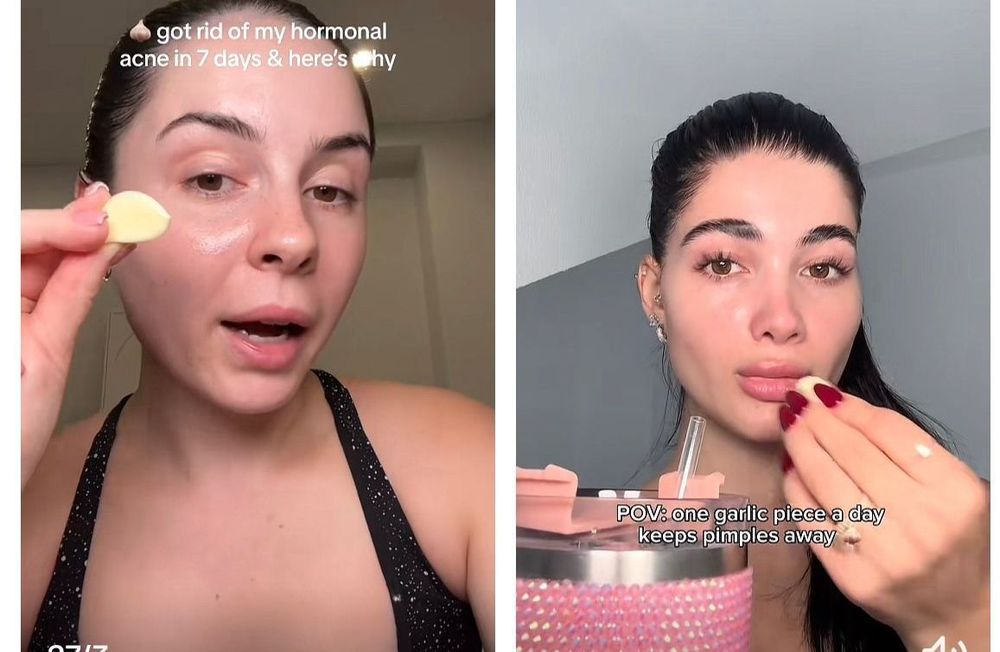Acné : l’ail cru, le nouveau remède naturel anti-bouton ?