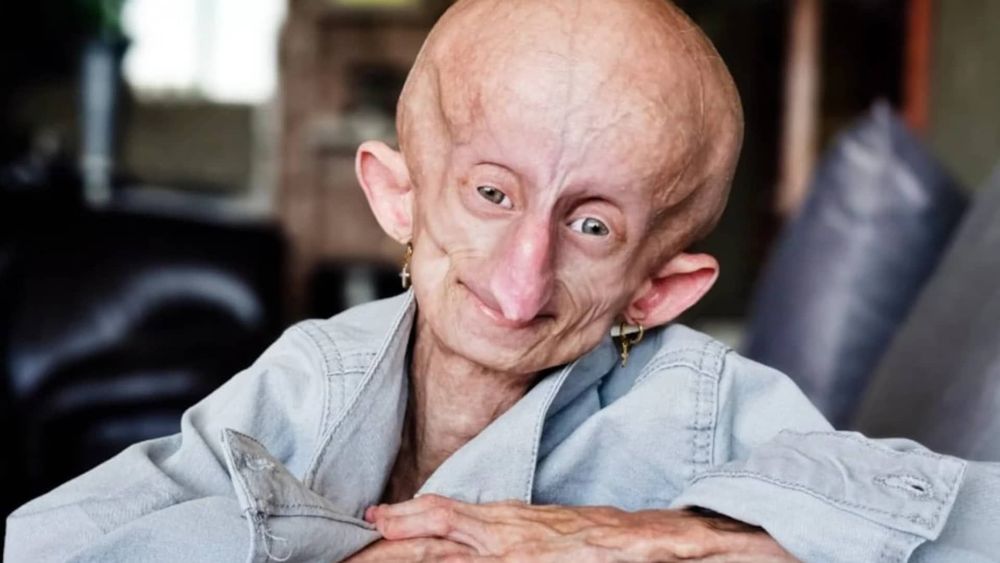Beandri Booysen : la célèbre TikTokeuse atteinte d'une maladie très rare est morte à seulement 19 ans