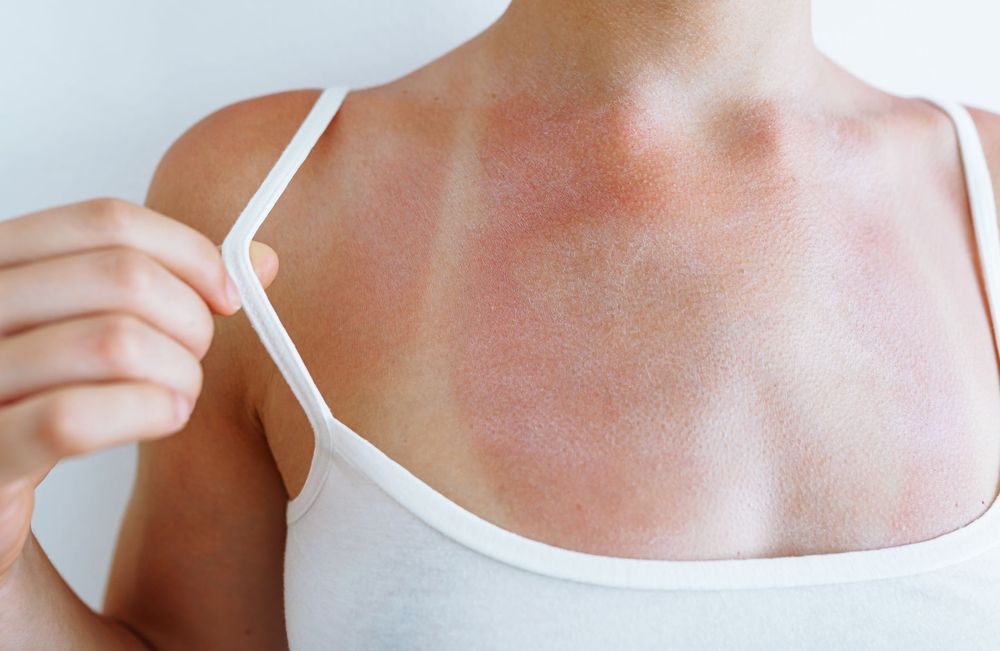 Yaourt, miel, melon... 6 remèdes naturels (et surprenants) pour soulager les coups de soleil