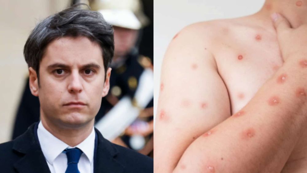 Variole du singe : l'OMS s'inquiète, Gabriel Attal annonce d'importantes mesures !