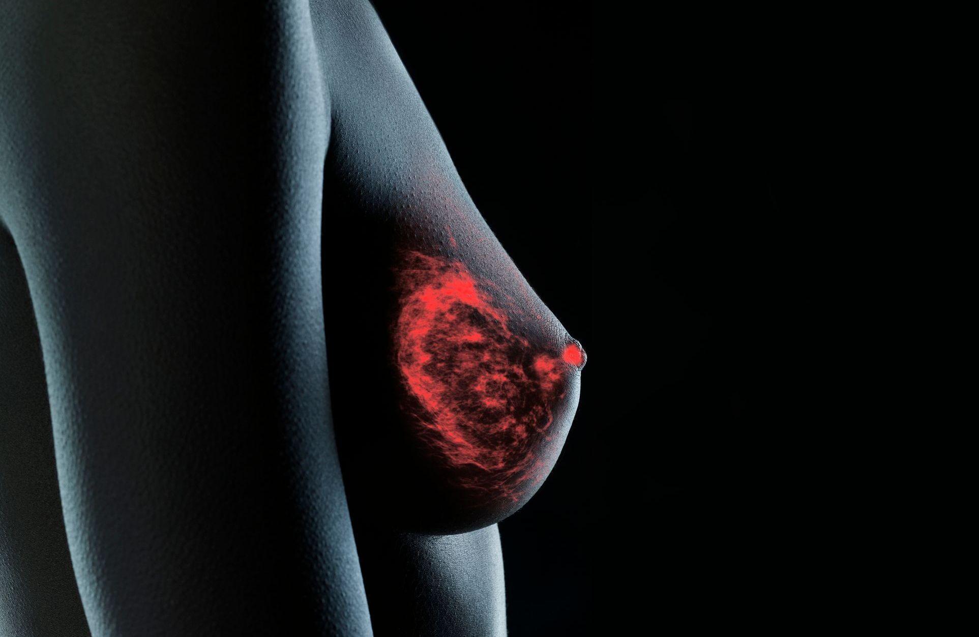 Cancer du sein : quels sont les premiers symptômes qui doivent vous inquiéter ?